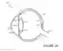 Fig. 02 - CORNEAL MULTI-PLANE INCISION USING A SURGICAL LASER SETUP CALCULATIONS INTERFACE