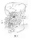 Fig. 06 - External tibial mill guide and method of use