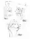 Fig. 02 - Method and apparatus for performing knee arthroplasty