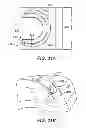 Fig. 28 - Surgical Needle with Steps and Flats