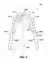 Fig. 09 - Surgical Clip Having Comliant Portion