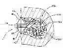 Fig. 01 - Assembly and method for left atrial appendage occlusion