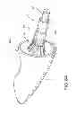Fig. 09 - Assembly and method for left atrial appendage occlusion