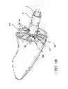 Fig. 10 - Assembly and method for left atrial appendage occlusion