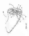 Fig. 11 - Assembly and method for left atrial appendage occlusion