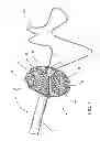 Fig. 02 - Assembly and method for left atrial appendage occlusion