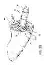 Fig. 10 - Assembly and method for left atrial appendage occlusion