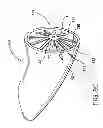 Fig. 11 - Assembly and method for left atrial appendage occlusion