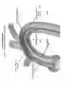 Fig. 07 - SYSTEM FOR FACILITATING TRANSCATHETER AORTIC VALVE PROCEDURES USING FEMORAL ACCESS