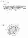 Fig. 03 - Surgical anchor delivery system