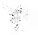 Fig. 32 - Low profile dual locking fixation system and offset anchor member