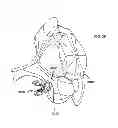 Fig. 36 - Low profile dual locking fixation system and offset anchor member
