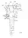 Fig. 46 - Low profile dual locking fixation system and offset anchor member