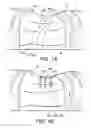 Fig. 02 - Methods and devices for improving percutaneous access in minimally invasive surgeries