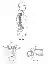 Fig. 02 - PEDICLE SCREW ASSEMBLY