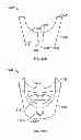 Fig. 16 - PEDICLE SCREW ASSEMBLY
