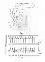 Fig. 02 - Active implantable medical device type such as a pacemaker with detection of anodal stimulation by analysis of a vectogram