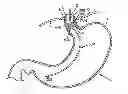 Fig. 01 - Controlled vagal blockage therapy