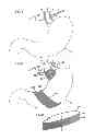 Fig. 05 - Controlled vagal blockage therapy