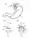 Fig. 06 - Controlled vagal blockage therapy