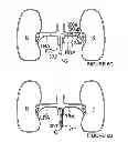 Fig. 06 - Methods for bilateral renal neuromodulation via catheter apparatuses having expandable baskets
