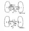 Fig. 08 - Methods for bilateral renal neuromodulation via catheter apparatuses having expandable baskets
