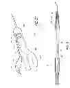 Fig. 07 - Luminal stenting
