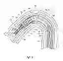 Fig. 10 - Luminal stenting