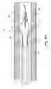 Fig. 13 - Luminal stenting