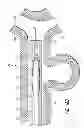 Fig. 22 - Luminal stenting