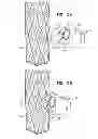 Fig. 03 - Stent fixation with reduced plastic deformation