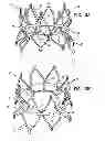 Fig. 04 - Stent fixation with reduced plastic deformation