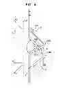 Fig. 07 - Stent fixation with reduced plastic deformation