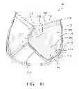 Fig. 03 - Planar zone in prosthetic heart valve leaflet