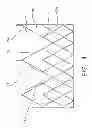 Fig. 08 - Planar zone in prosthetic heart valve leaflet
