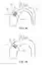 Fig. 08 - Truncated leaflet for prosthetic heart valves, preformed valve