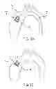 Fig. 07 - Vertical coaptation zone in a planar portion of prosthetic heart valve leaflet