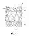 Fig. 03 - Prosthetic heart valve with leaflet shelving