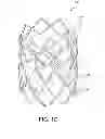Fig. 04 - Prosthetic heart valve with leaflet shelving