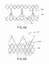 Fig. 14 - Prosthetic heart valve with leaflet shelving