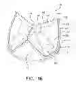 Fig. 19 - Prosthetic heart valve with leaflet shelving