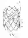 Fig. 04 - Geometric prosthetic heart valves
