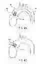 Fig. 10 - Geometric prosthetic heart valves