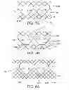 Fig. 13 - Geometric prosthetic heart valves