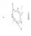 Fig. 05 - Epicardial clip