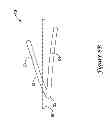 Fig. 16 - Epicardial clip