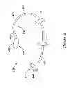 Fig. 20 - Epicardial clip