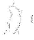 Fig. 23 - Epicardial clip