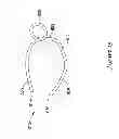 Fig. 24 - Epicardial clip