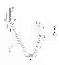 Fig. 26 - Epicardial clip